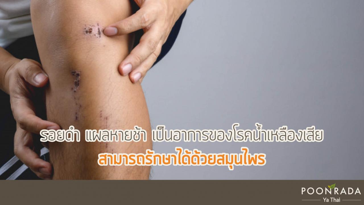 ขาลาย รอยดำ แพ้ยุง รักษาที่ต้นเหตุด้วยสมุนไพร ขาลาย รอยดำ แพ้ยุง รักษาที่ต้นเหตุด้วยสมุนไพร