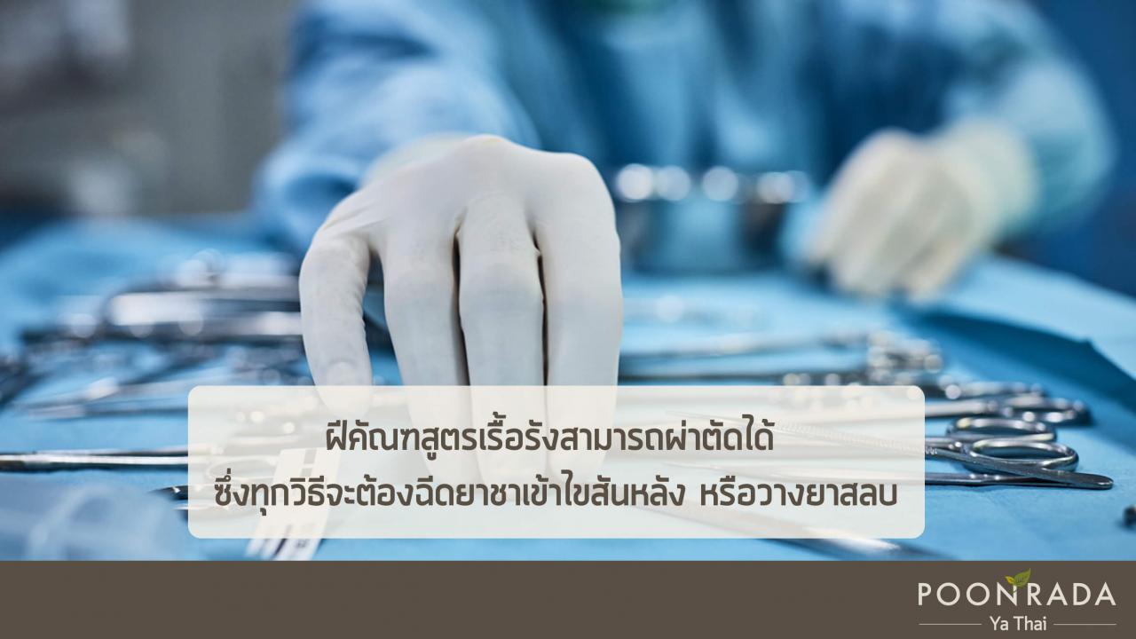 ผ่าตัดฝีคัณฑสูตร_จำเป็นไหม-2