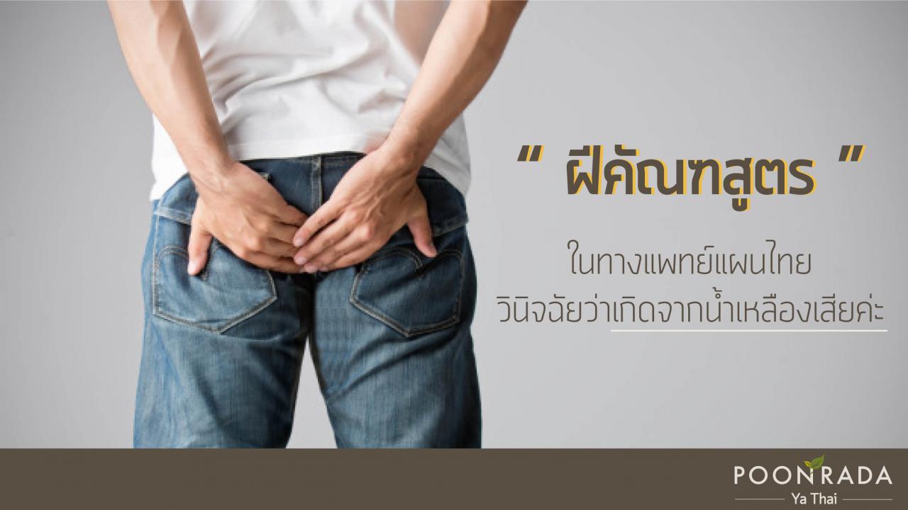 ฝีคัณฑสูตร_ฝีที่ก้น_เกิดจากอะไร-4