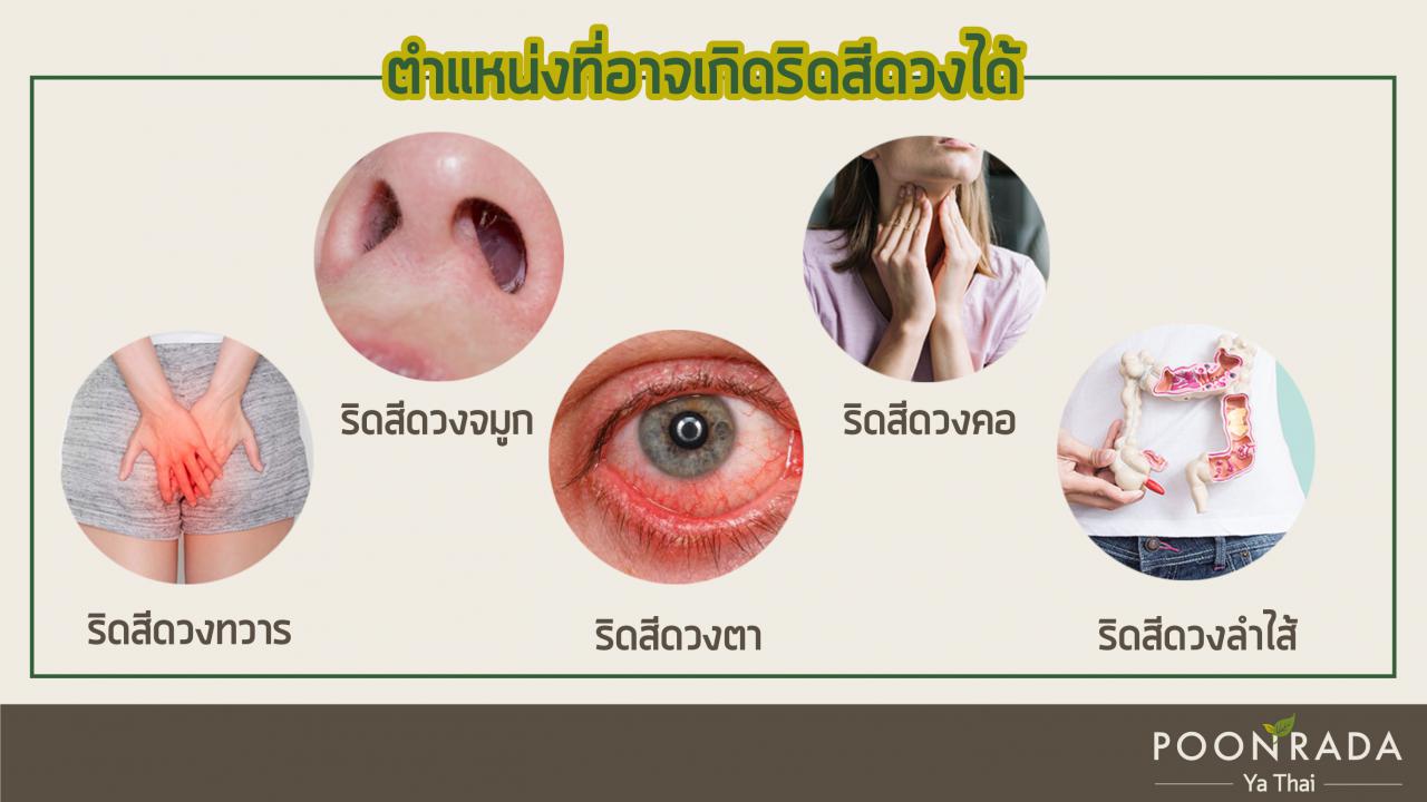 ริดสีดวงเป็นได้กี่ที่-3