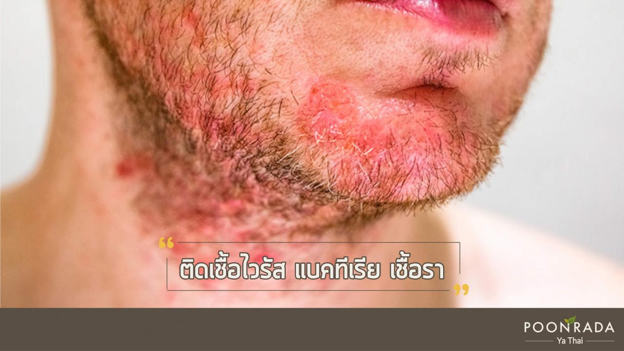 6_สาเหตุของโรคน้ำเหลืองเสีย-7