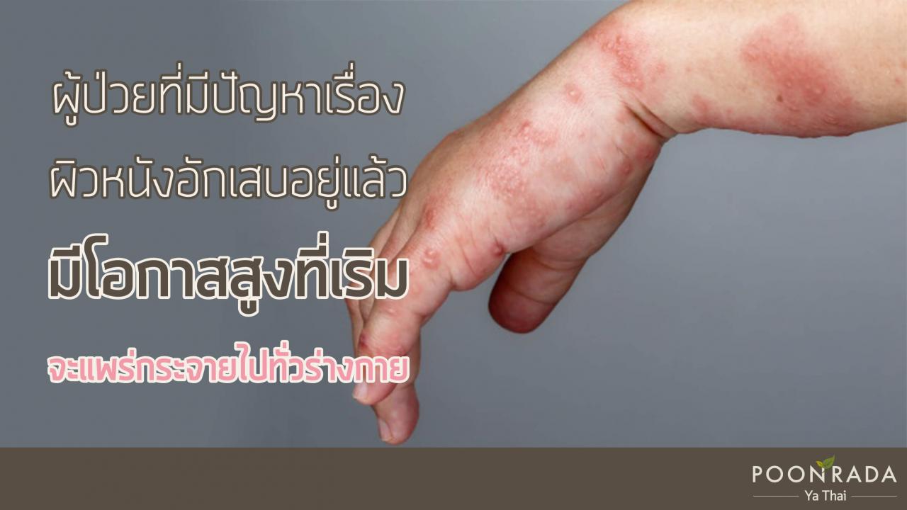 ปล่อยให้เป็นเริมนานๆ_ระวังภาวะแทรกซ้อน-2