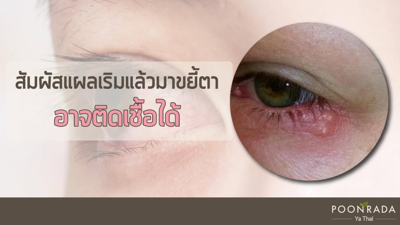 ปล่อยให้เป็นเริมนานๆ_ระวังภาวะแทรกซ้อน-3