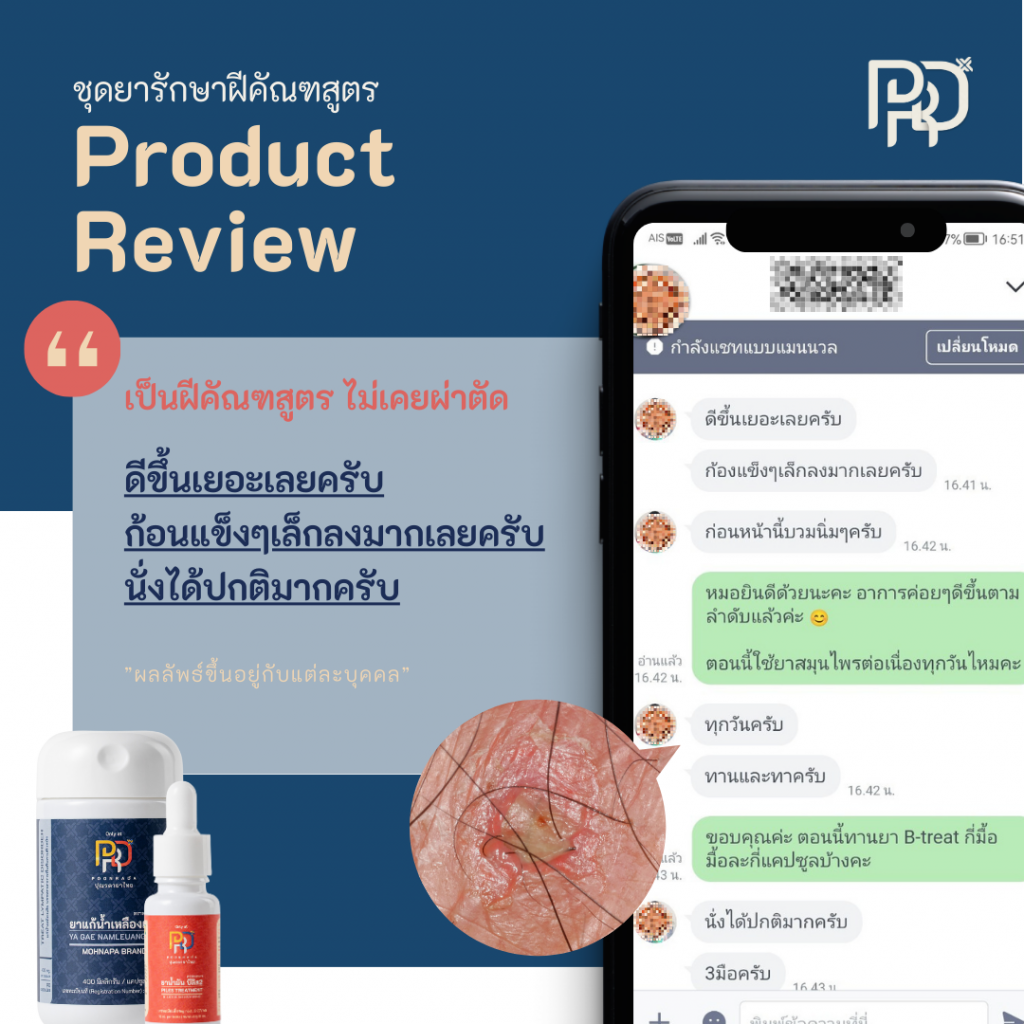 รีวิว4 ยารักษาฝีคัณฑสูตรและฝีที่ก้น A-set ไม่เคยผ่าตัด