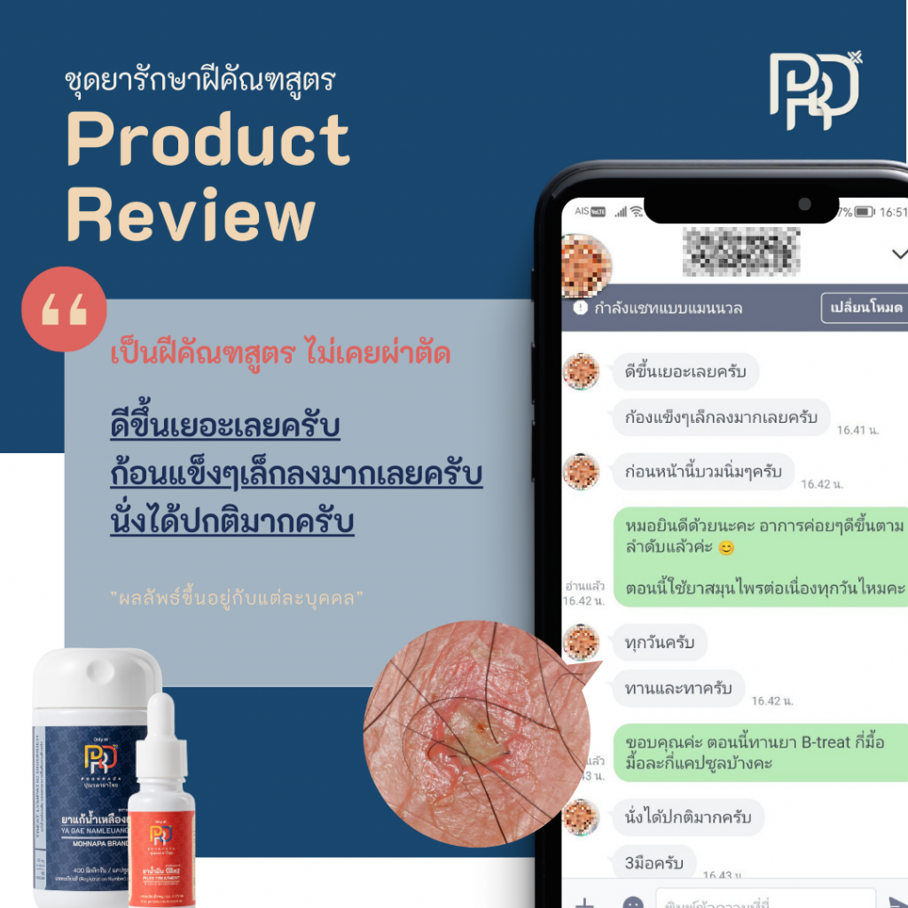 รีวิว4 ชุดรักษาฝฝีคัณฑสูตร A-set ไม่เคยผ่าตัด