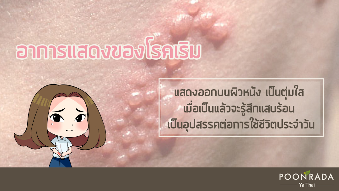 เริมเกิดจากอะไร ทำไมเป็นแล้วไม่หาย1