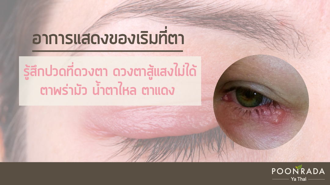 ริดสีดวงทวาร หายเองได้ไหม3