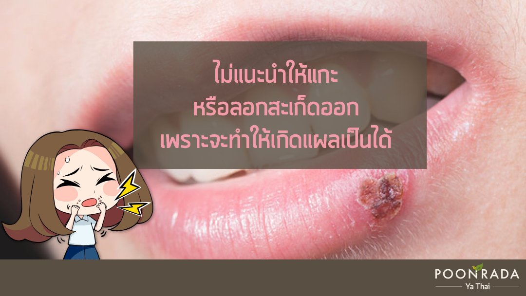 แผลเป็นจากเริม รักษาอย่างไร1