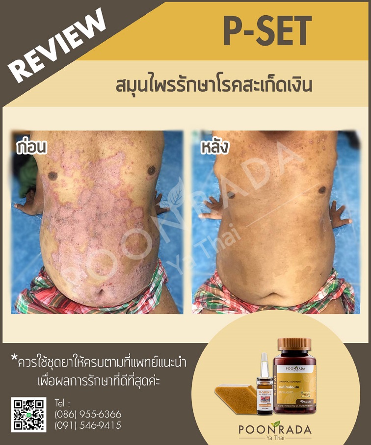 รีวิวชุดรักษาสะเก็ดเงิน3