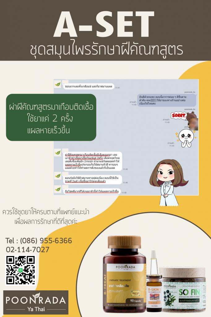 รีวิวรักษาฝีคัณฑสูตรด้วยสมุนไพรA-SET2 คนที่1