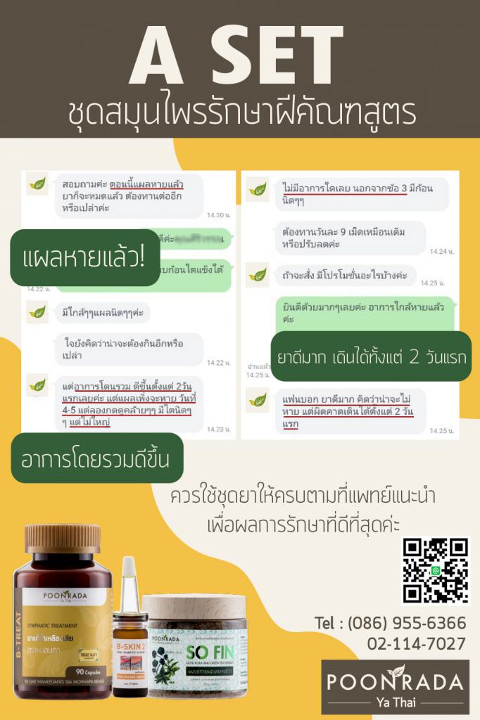 รีวิวรักษาฝีคัณฑสูตรด้วยสมุนไพรA-SET2 คนที่3