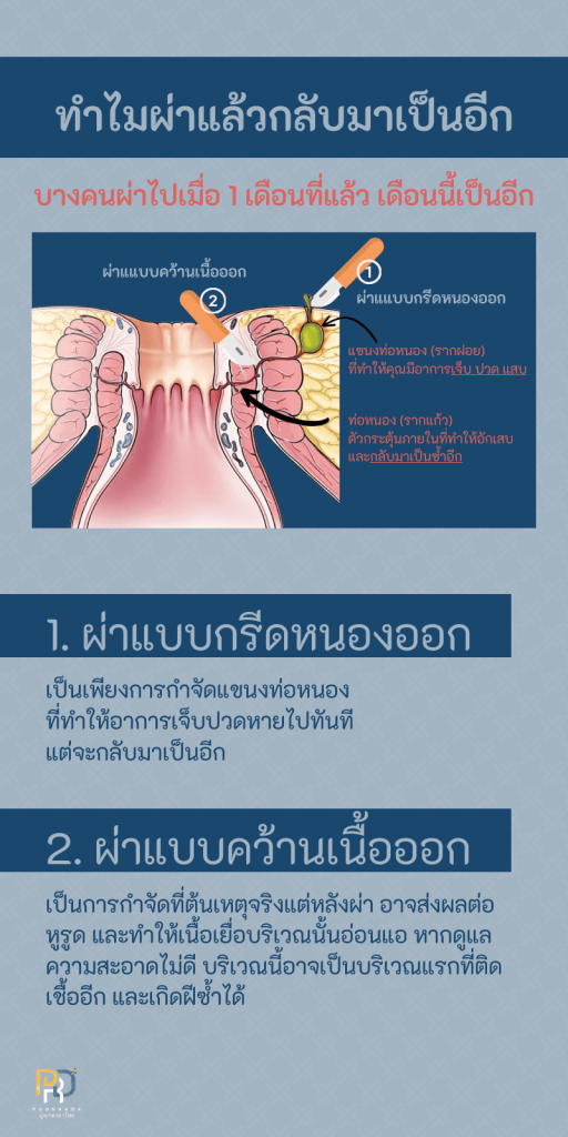 ผ่าฝีคัณฑสูตร