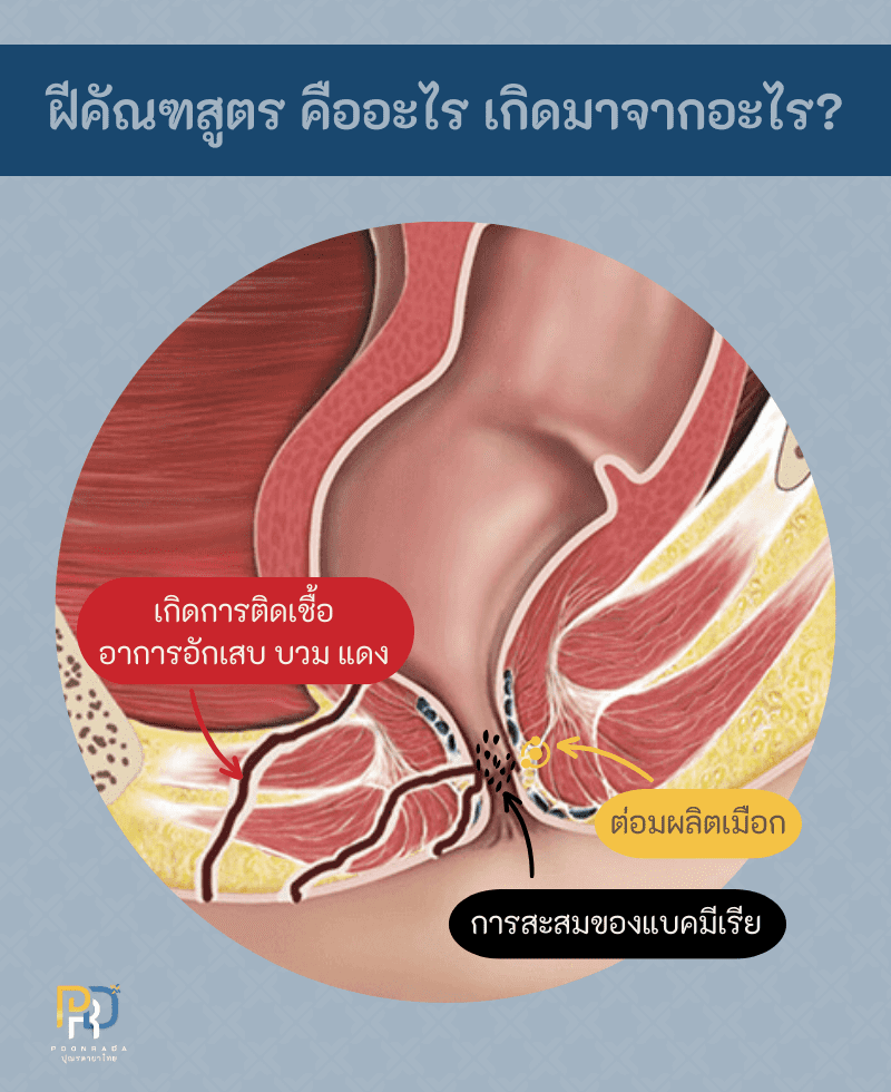 สมุนไพรรักษาฝีคัณฑสูตร 2