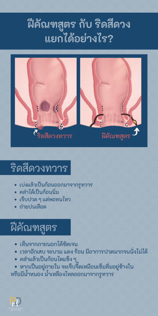 สมุนไพรรักษาฝีคัณฑสูตร 3