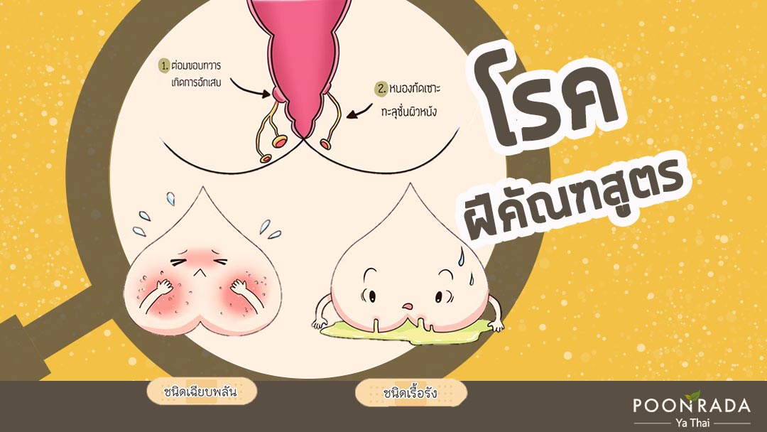 โรคฝีคัณฑสูตร ฝีที่ก้น คืออะไร?