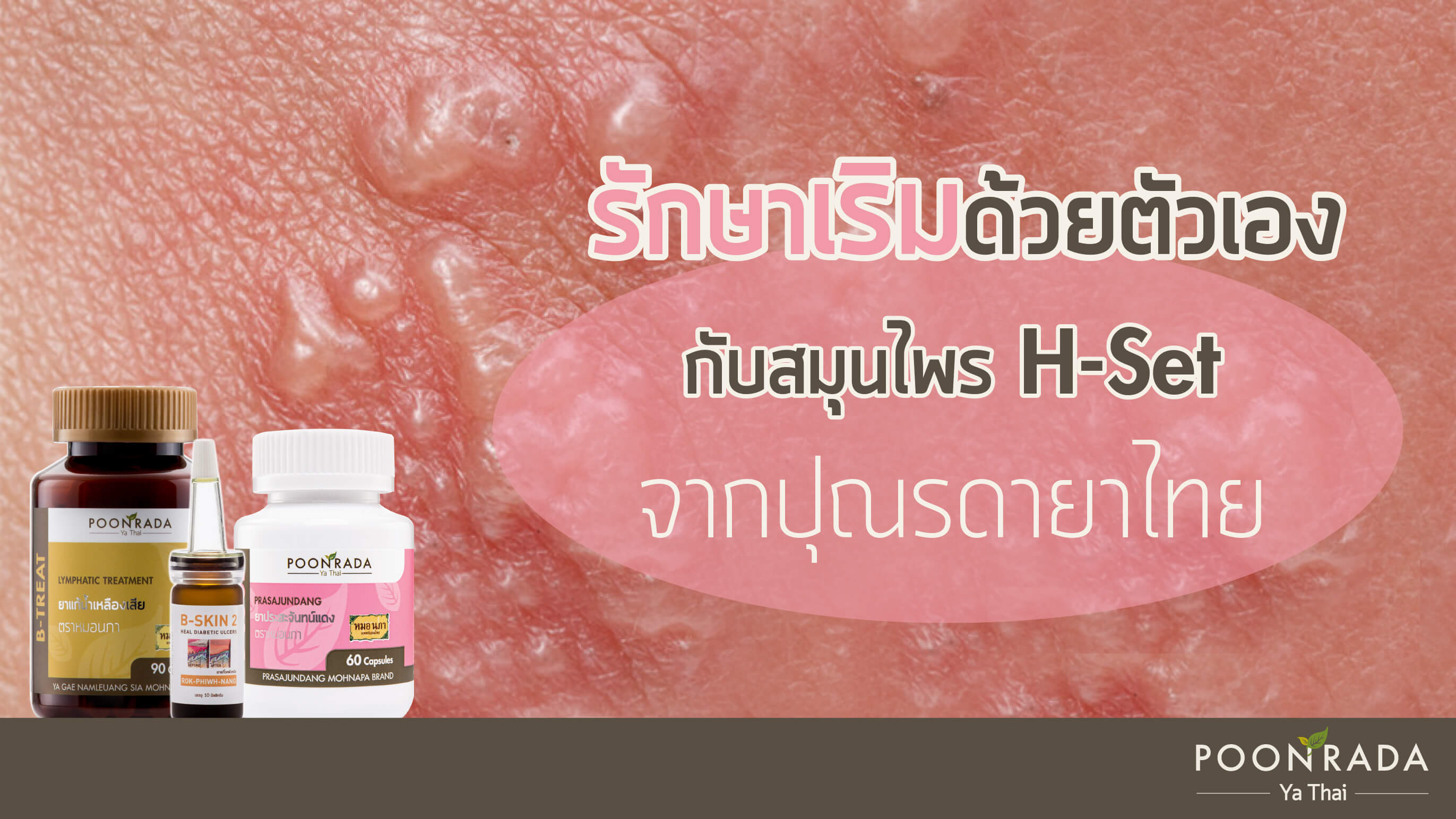 รักษาเริมด้วยตัวเองกับสมุนไพร H-Set จากปุณรดายาไทย