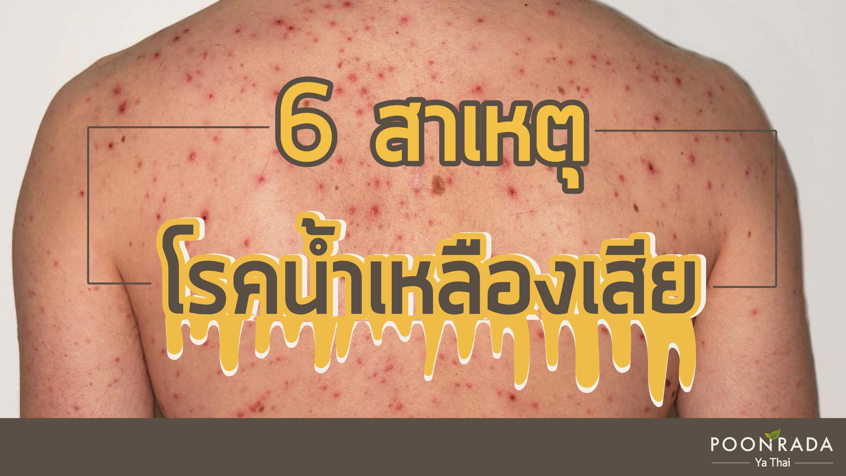 6 สาเหตุของโรคน้ำเหลืองเสีย