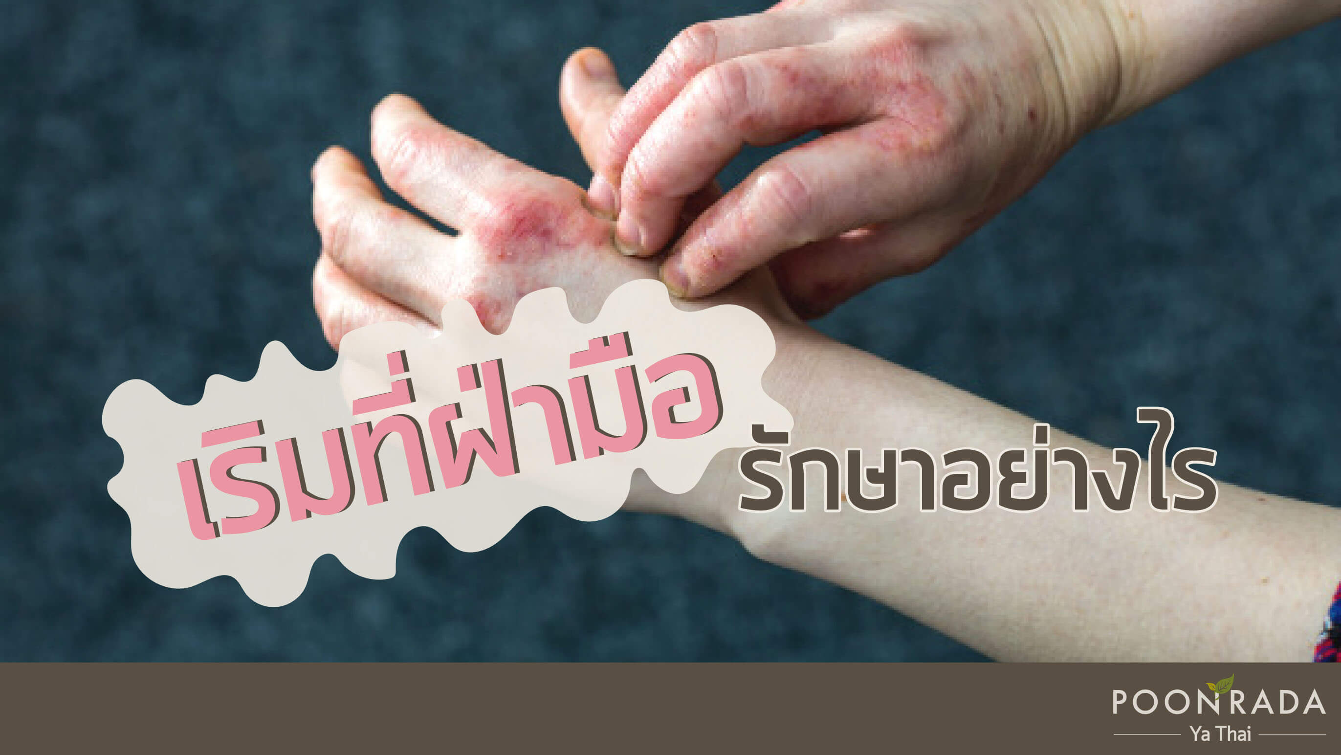 เริมที่ฝ่ามือ รักษาอย่างไร