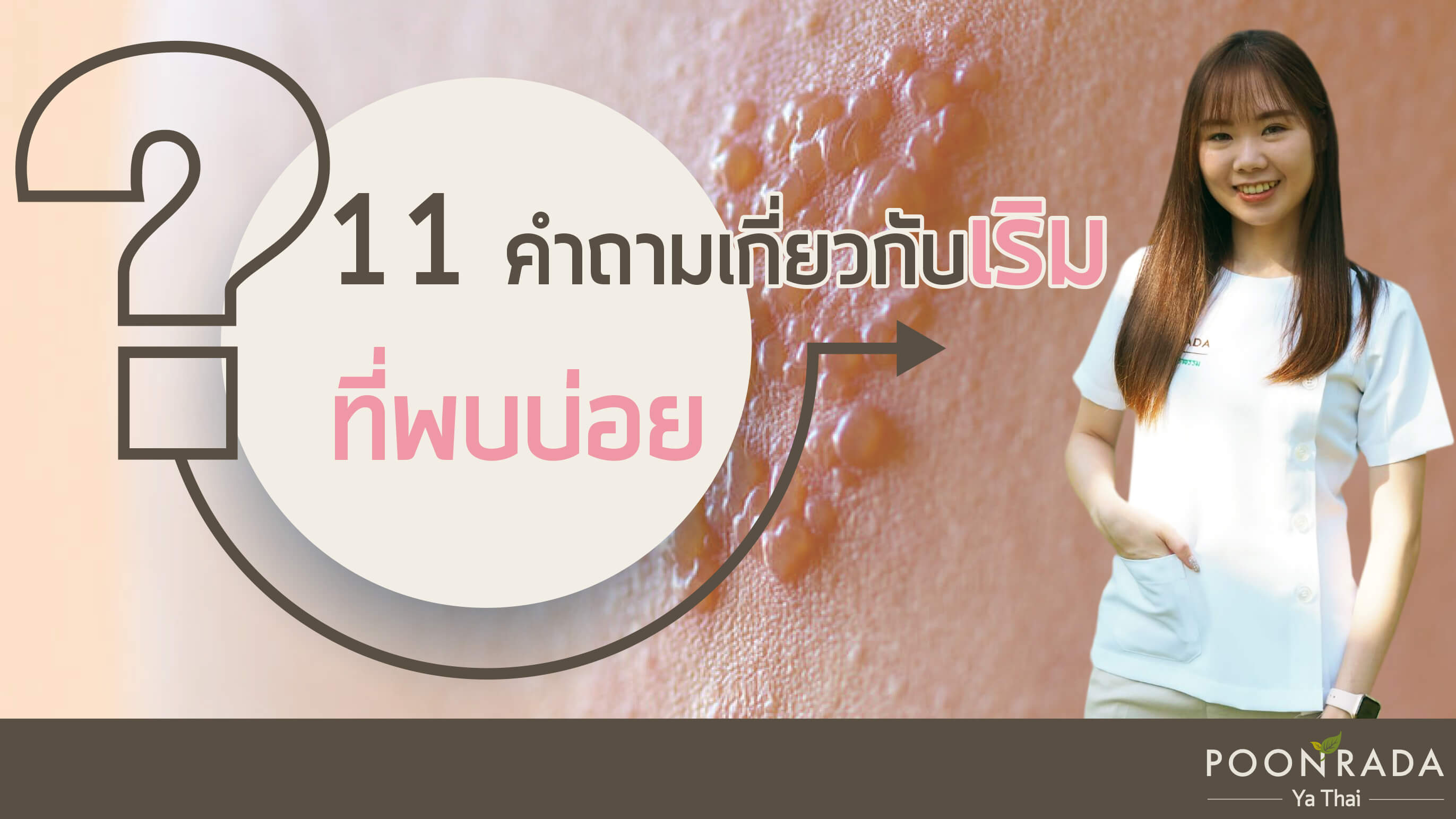 11 คำถามเกี่ยวกับเริมที่พบบ่อย