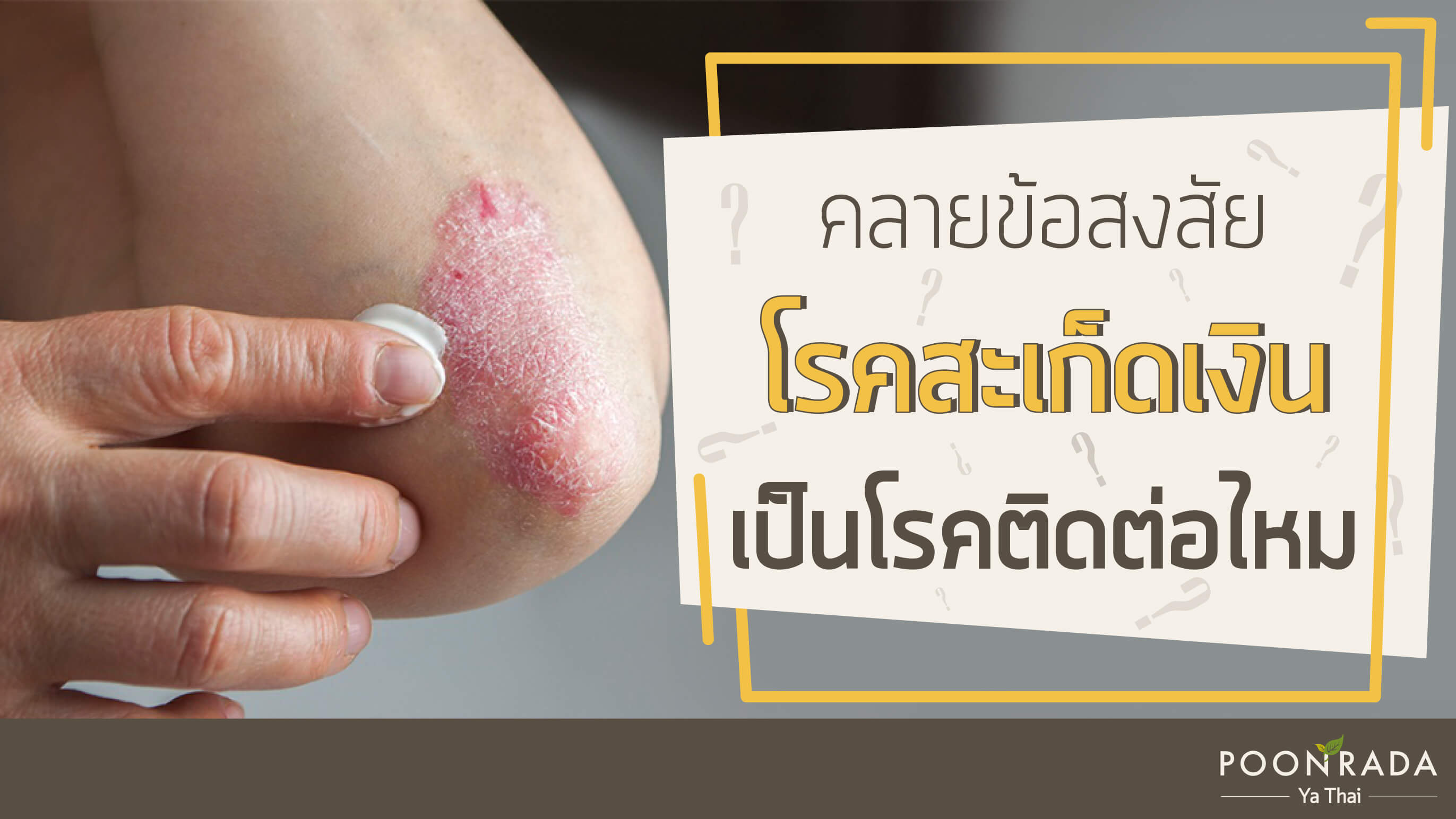 คลายข้อสงสัย สะเก็ดเงินเป็นโรคติดต่อไหม?