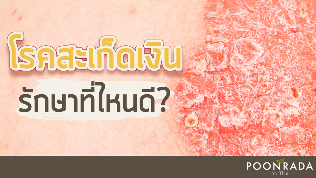 โรคสะเก็ดเงินรักษาที่ไหนดี