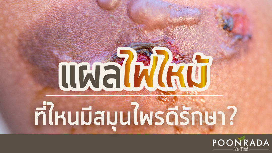 แผลไฟไหม้ ที่ไหนมีสมุนไพรดีรักษา