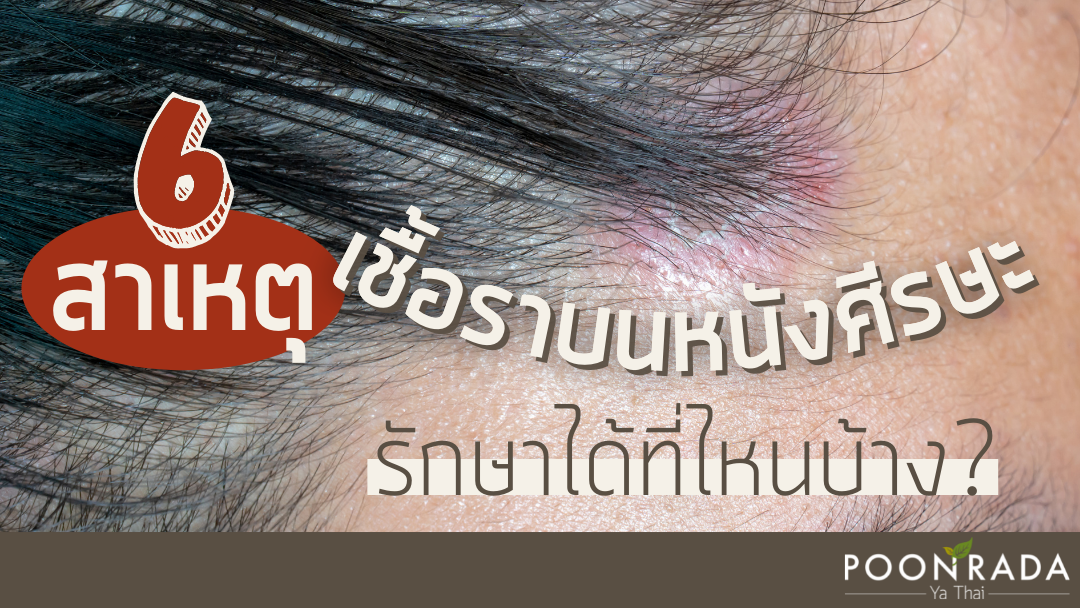 6 สาเหตุเชื้อราบนหนังศีรษะ รักษาได้ที่ไหนบ้าง?