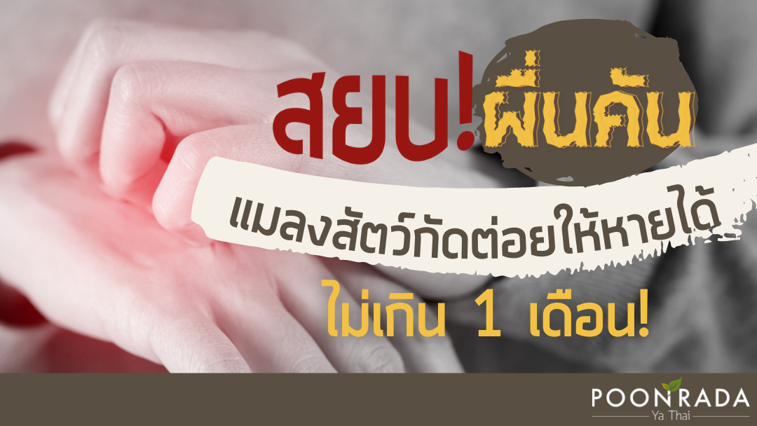 สยบผื่นคัน แมลงสัตว์กัดต่อยให้หายได้ ไม่เกิน 1 เดือน! (ฉบับหมอป๊อป)