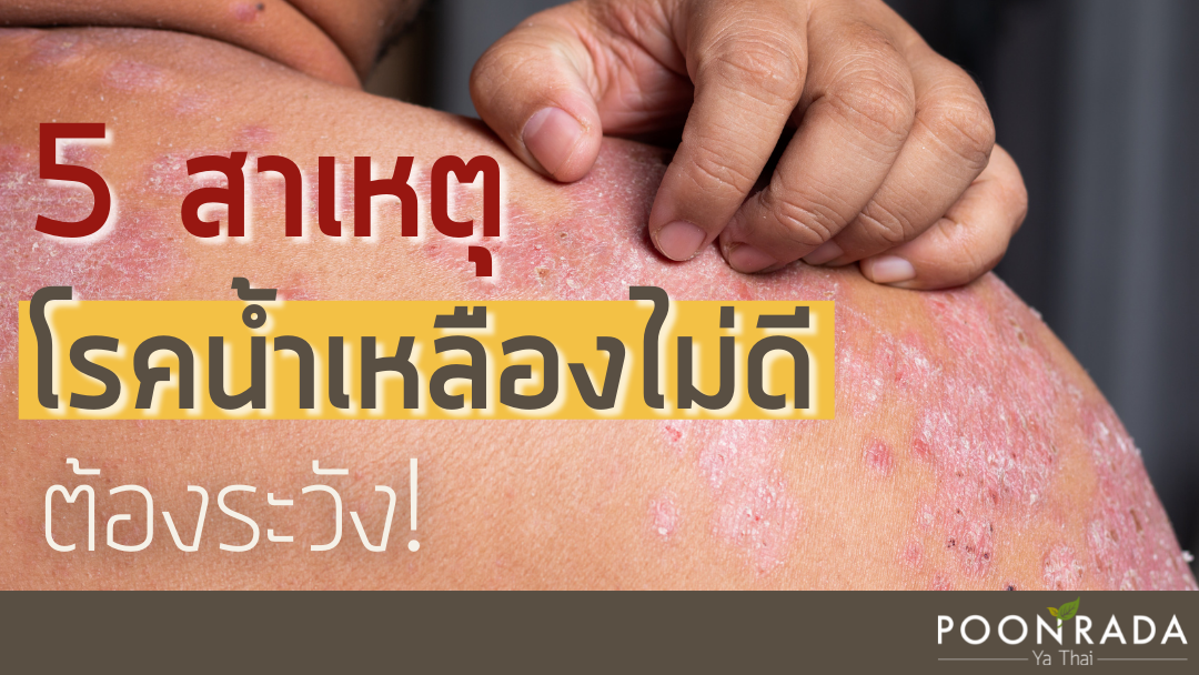 5สาเหตุ โรคน้ำเหลืองไม่ดี ต้องระวัง!