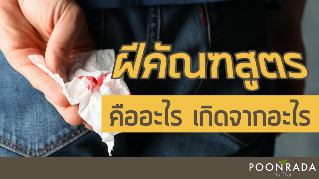 ฝีคัณฑสูตร คืออะไร เกิดได้อย่างไร และ แตกต่างจาก ริดสีดวงทวารยังไง?