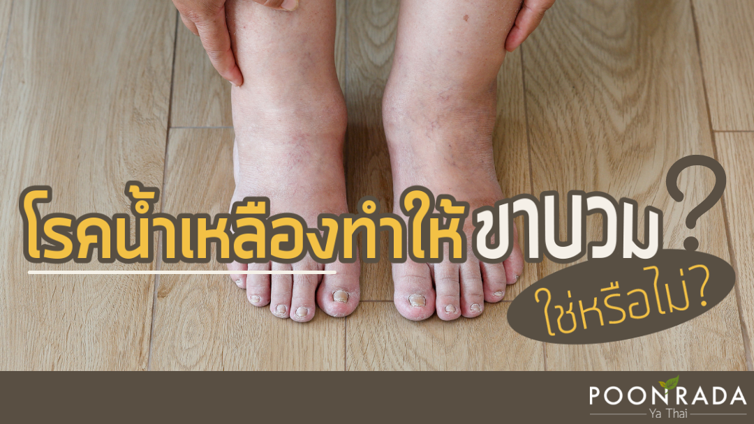 โรคน้ำเหลือง ทำให้ขาบวมใช่หรือไม่?