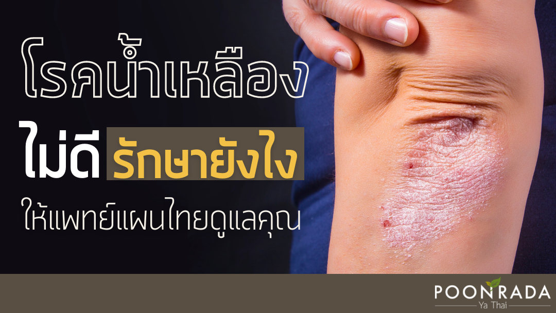 โรคน้ำเหลืองไม่ดี รักษายังไง? ให้แพทย์แผนไทยดูแลคุณ