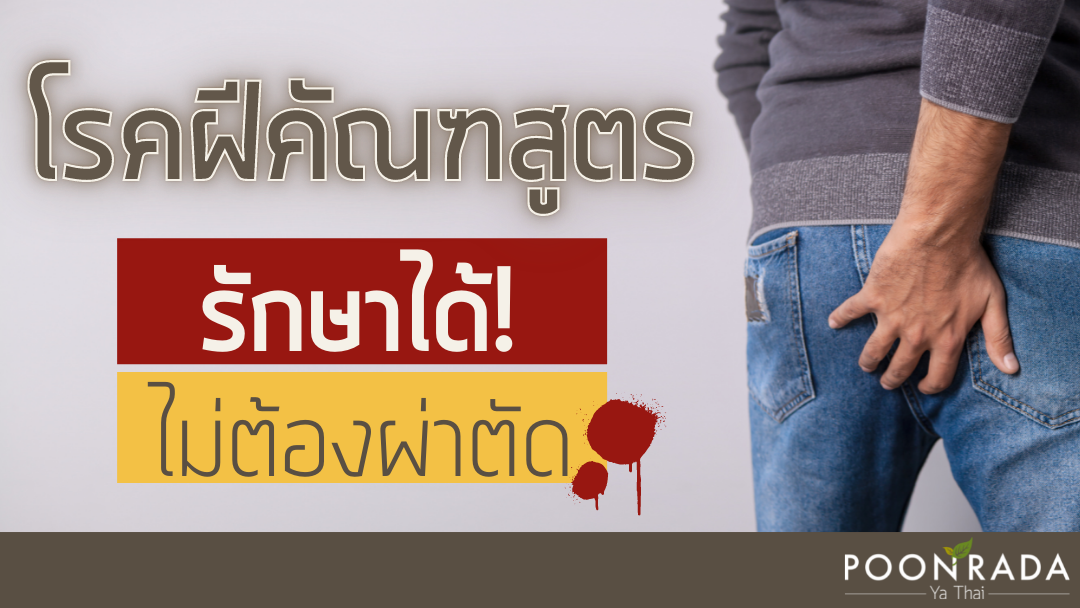 โรคฝีคัณฑสูตร รักษาได้ ไม่ต้องผ่าตัด!