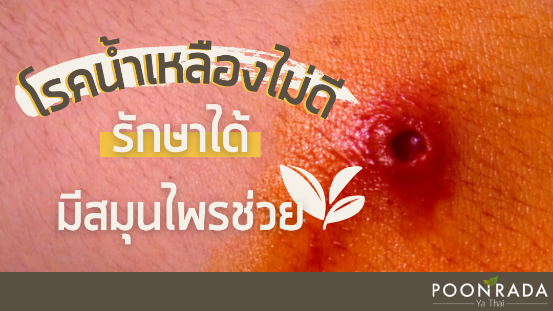 โรคน้ำเหลืองไม่ดี รักษาได้ มีสมุนไพรช่วย!