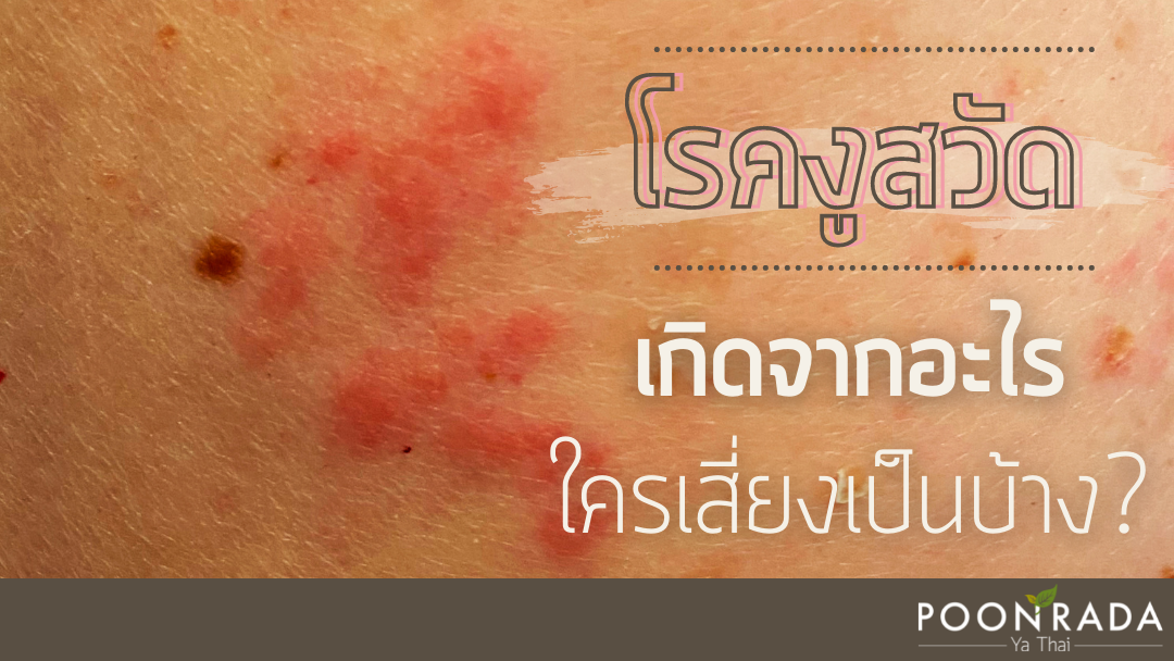 โรคงูสวัด เกิดจากอะไร ใครเสี่ยงเป็นบ้าง?