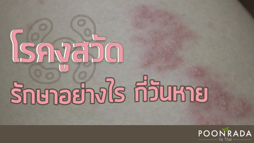 โรคงูสวัด รักษาอย่างไร กี่วันหาย?