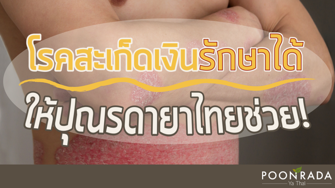 โรคสะเก็ดเงินรักษาได้ ให้ปุณรดายาไทยช่วย!