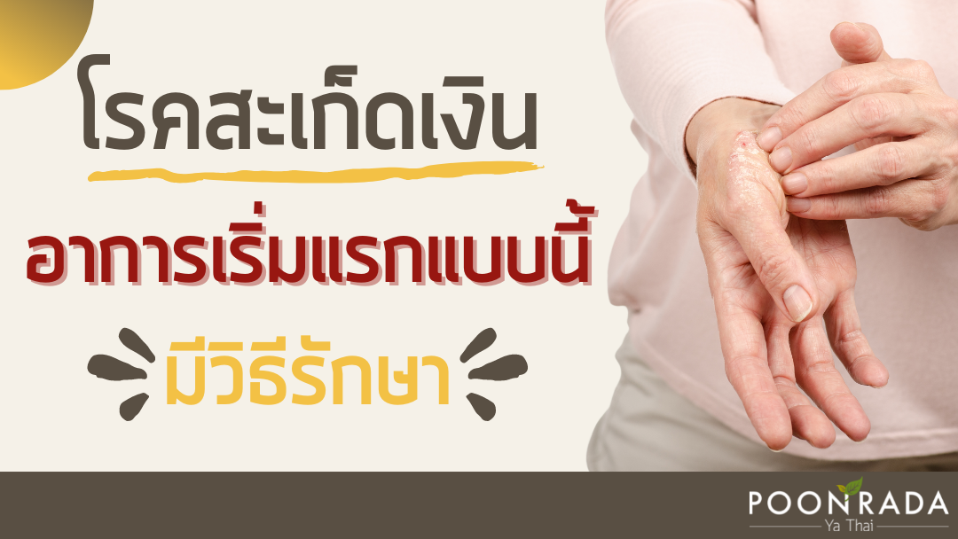 โรคสะเก็ดเงินอาการเริ่มแรกแบบนี้ มีวิธีรักษา!