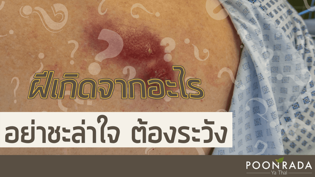 ฝีเกิดจากอะไร อย่าชะล่าใจต้องระวัง!