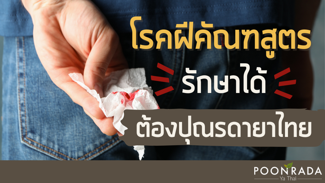 โรคฝีคัณฑสูตร รักษาได้! ต้องปุณรดายาไทย