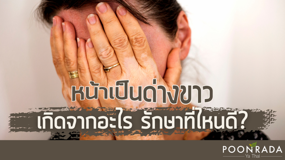 หน้าเป็นด่างขาวเกิดจากอะไร รักษาที่ไหนดี?