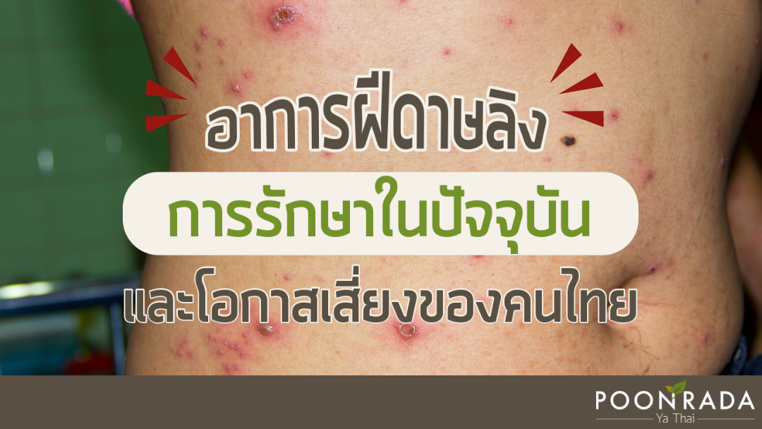 อาการของฝีดาษลิง การรักษาในปัจจุบันและโอกาสเสี่ยงของคนไทย