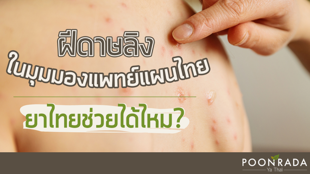 ฝีดาษลิง ในมุมมองแพทย์แผนไทย ยาไทยช่วยได้ไหม?