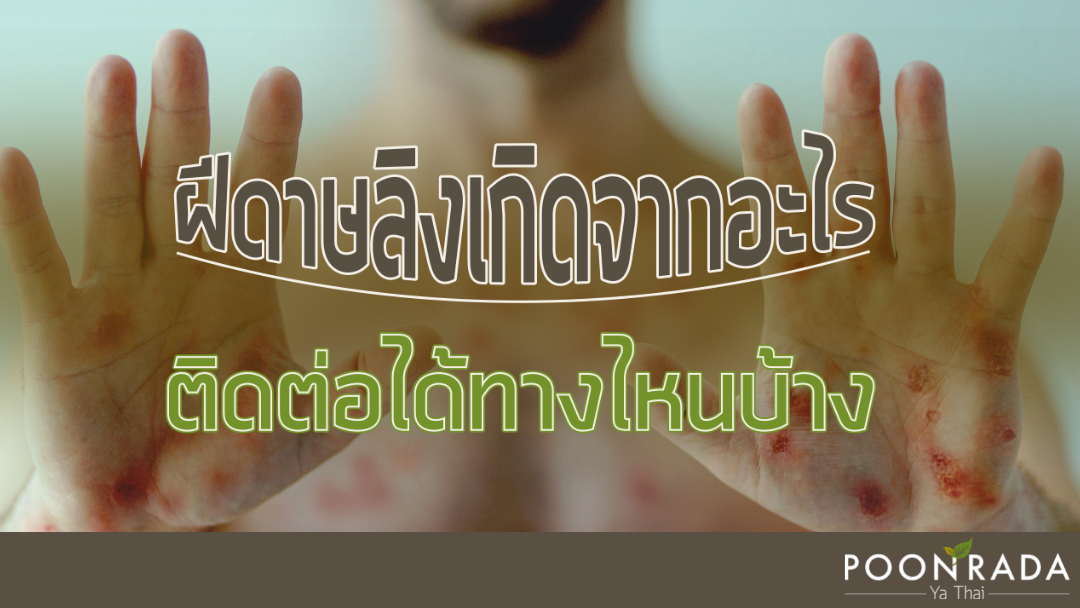 ฝีดาษลิงเกิดจากอะไร ติดต่อได้ทางไหนบ้าง