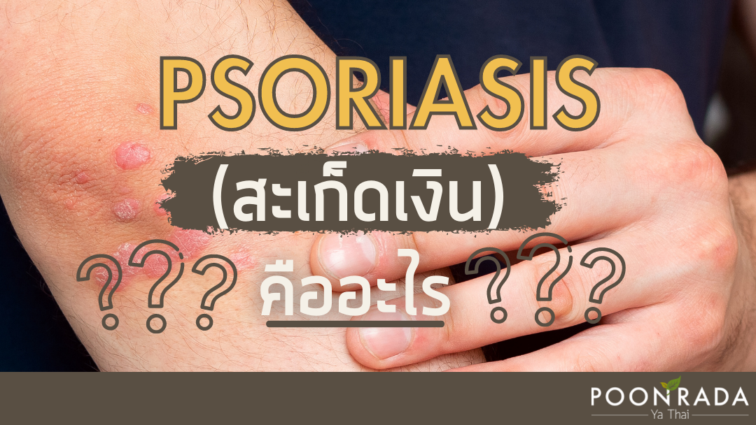 Psriasis(สะเก็ดเงิน) คืออะไร?