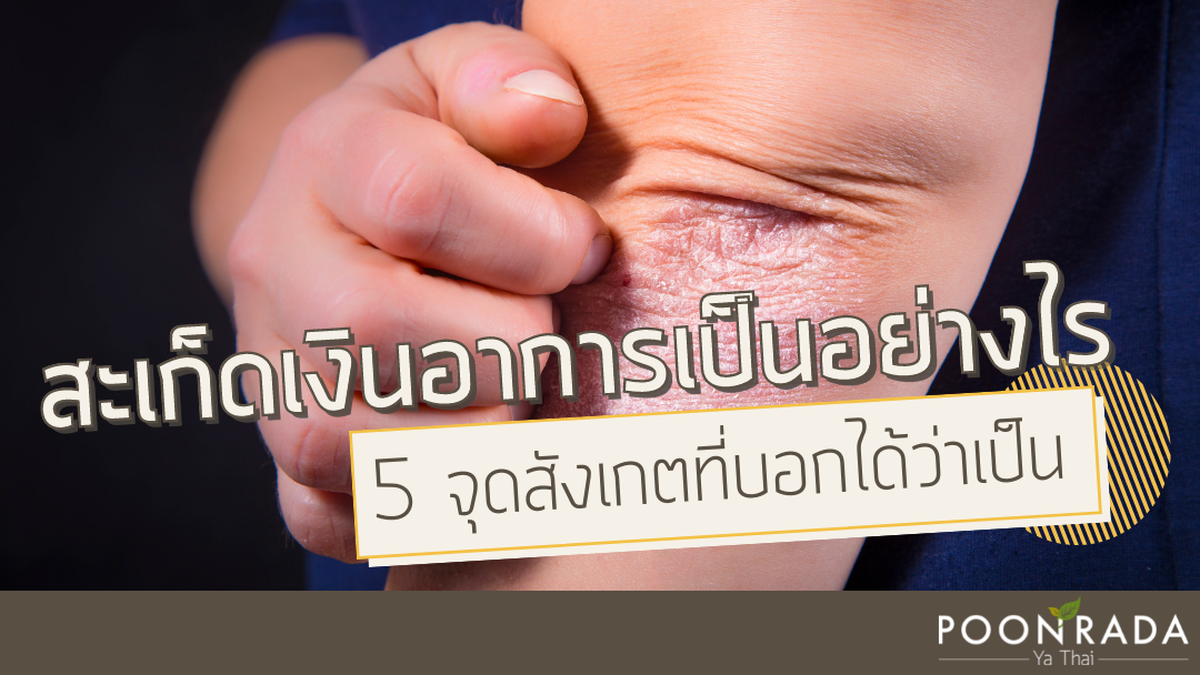 สะเก็ดเงินอาการเป็นอย่างไร? 5จุดที่สังเกตได้ว่าเป็นสะเก็ดเงิน