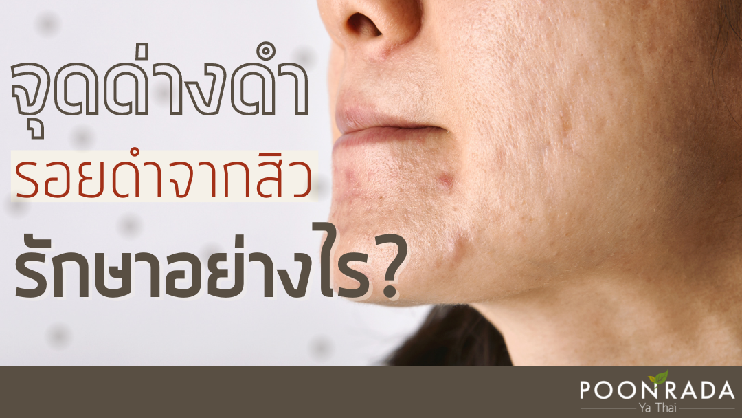 จุดด่างดำ รอยดำจากสิว รักษาอย่างไร