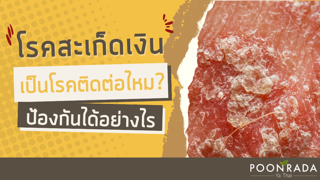 โรคสะเก็ดเงินเป็นโรคติดต่อไหม? ป้องกันอย่างไร