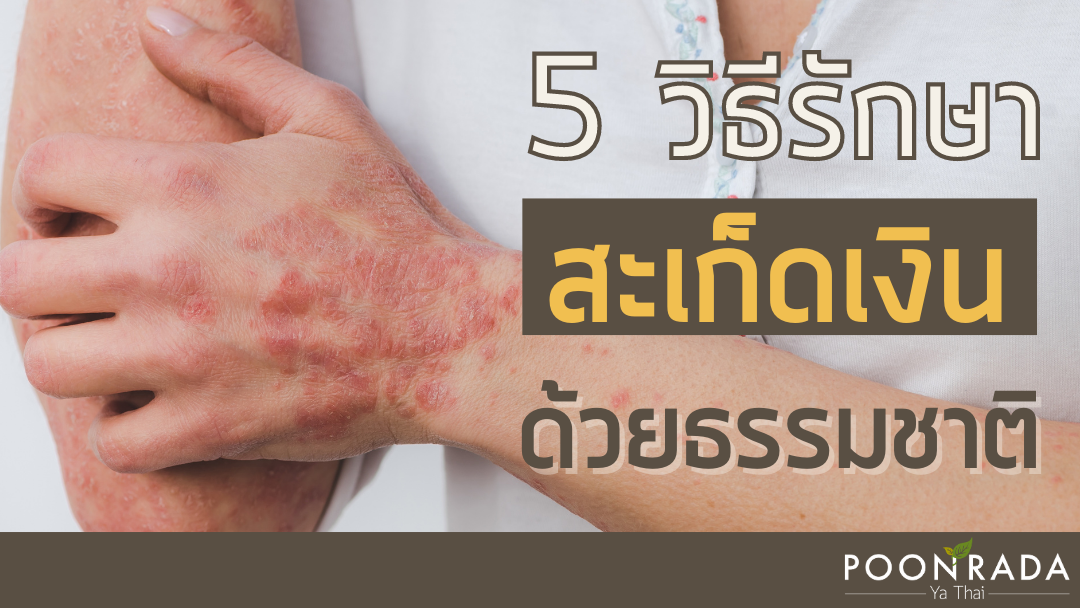 5วิธีรักษาสะเก็ดเงินด้วยธรรมชาติ