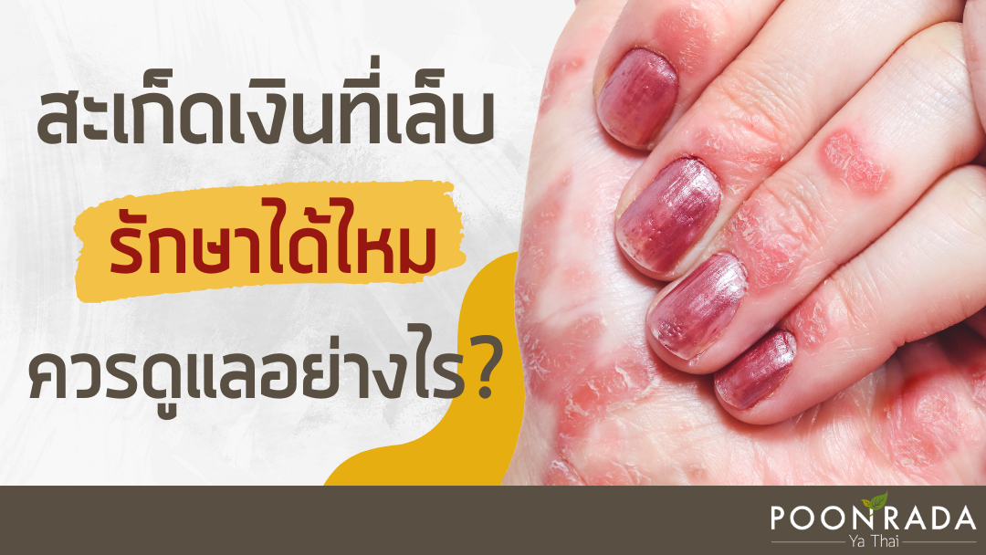 สะเก็ดเงินที่เล็บรักษาได้ไหม? ควรดูแลอย่างไร?